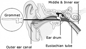 We put the grommet into the ear through the outer ear canal, and place it inside the eardrum, which adjoins the eustachian tube and middle ear.