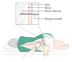 During a bone marrow test the biopsy needle enters the body through the hip. Close up, the needle pierces the skin, bone and bone marrow