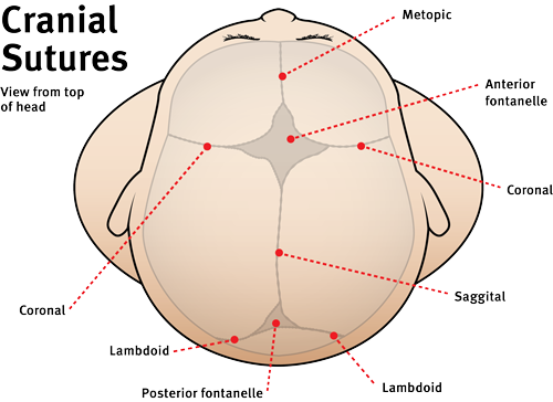 The top of a head, showing regions where cranial sutures can be fused. Along the centre line of the head, runnig from front to back lie the metopic, anterior fontanelle, saggital and posterior fontanelle sutures. Coronal sutures lie toward the front of the skull, above the ears. Lamboid sutures lie toward the base of the skull, on each side of the posterior fontanelle.