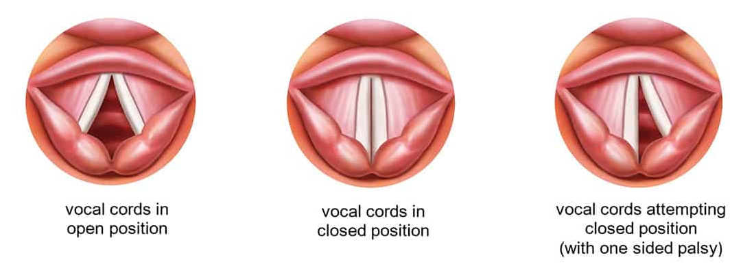 Illustration detailing the vocal cords in three states. Vocal cords open, vocal cords closed and vocal cords attempting closed position (with one side palsy). 
