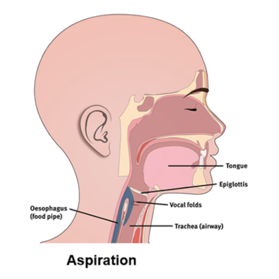 Diagram indicating physiology that causes aspiration during swallowing.