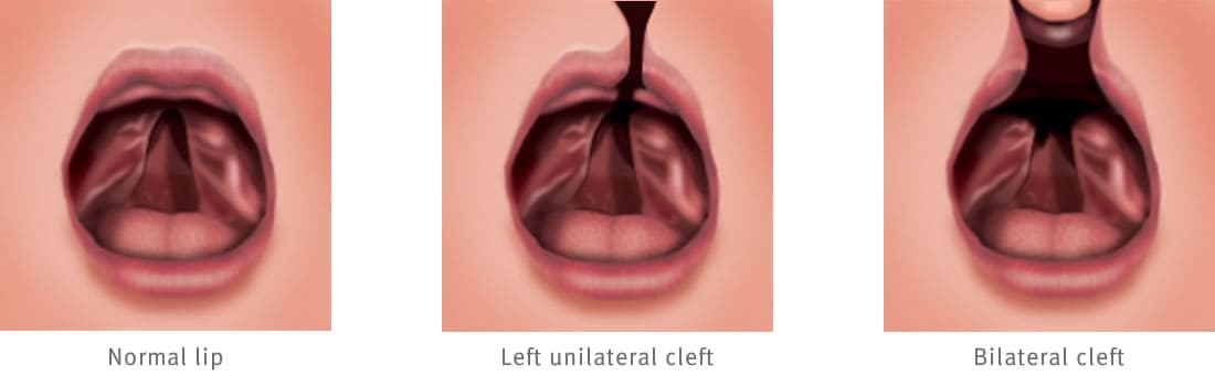 Open mouth showing normal lip, open mouth showing left unilateral cleft stretching from top lip to nostril, and an open mouth showing a bilateral cleft that stretches from both sides of the lip to the nostril.