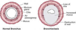 A normal bronchus has a wide hole to allow air through, in an affected bronchus, mucus fills the passage, blocking the flow of air, and destroying the bronchus walls.