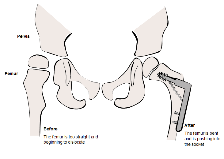 Before surgery, the femur is too straight and is beginning to dislocate from the pelvis. After surgery the femur is bent and is pushing into the socket of the pelvis.